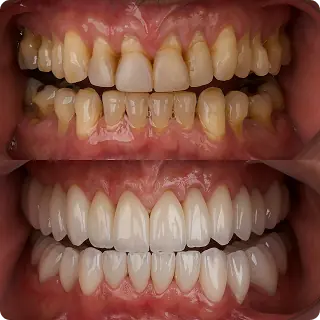 Resultado clínico Dr. Francis Lima